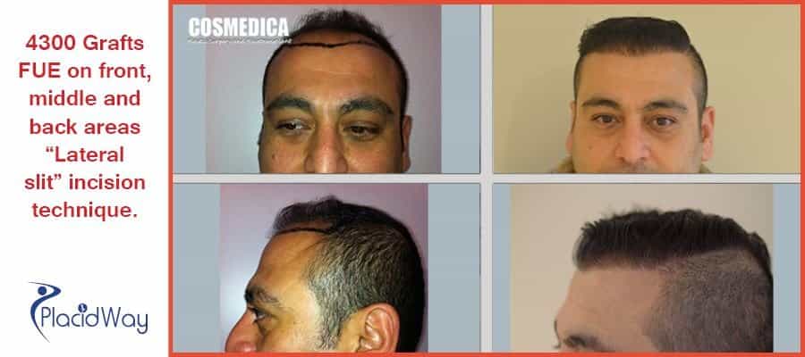 Before and After Hair Transplantation Procedure in Istanbul, Turkey